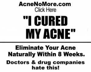imgad-acne